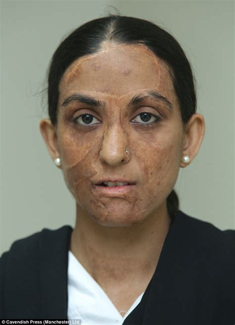 Women Scarred By Acid Attacks Have Reconstructive Surgery Daily Mail Online