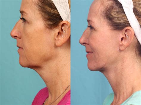 Neck Lift Before And After Pictures Case 496 Orlando Florida
