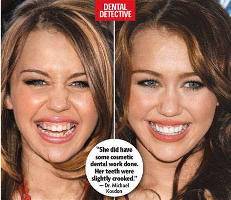 Told You Today Miley Cyrus Teeth Pictures Update