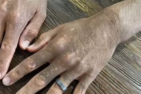Mans Skin Turns Grey As Top Doctors Stumped Over Cause