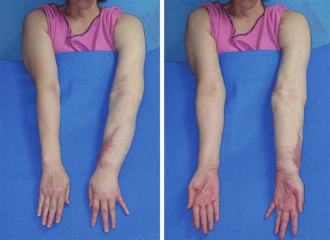 Eight Months Postoperative Follow Up The Arm Circumference Reduction