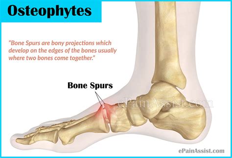 We did not find results for: Bone Spurs or Osteophytes: Treatment, Causes, Symptoms