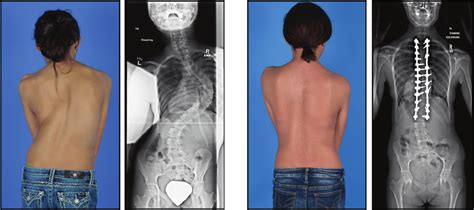 Adolescent Idiopathic Scoliosis In A Female Patient Photograph And