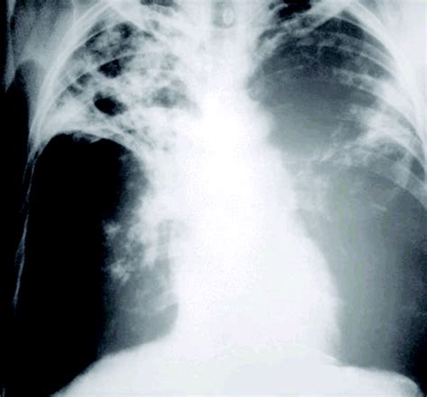 Pulmonary Tuberculosis Chest X Ray