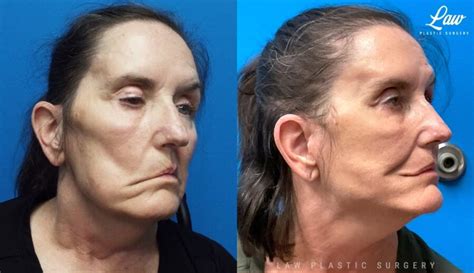 Facial Paralysis Surgery Before And After Photos Law Plastic Surgery