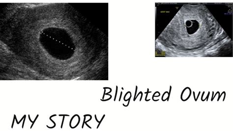 My Story Mistakenly Got Diagnosed With Blighted Ovum Youtube