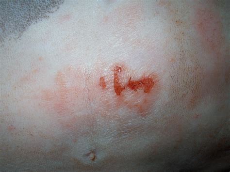Image Gallery Secondary Skin Lesions Clinicians Brief