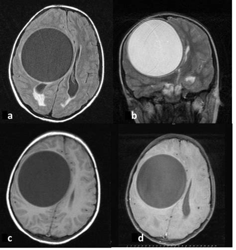 In The Mri Evaluation A Cystic Mass Of 88x84x83 Mm Was Detected Which