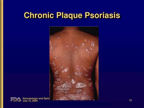 Ppt Introduction To Psoriasis Powerpoint Presentation Free Download