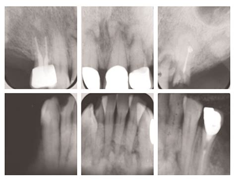 Periapical cemental dysplasia (pcd) is a benign odontogenic growth originating from mesenchyme tissue. Treatment Planning for Periapical Cemental Dysplasia ...