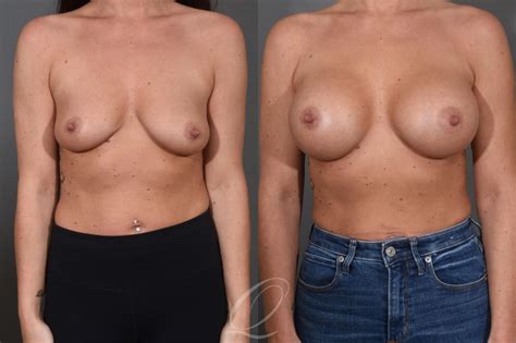 Breast Augmentation Before After Photos Patient Serving