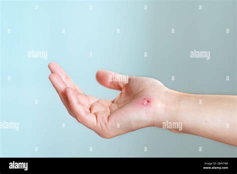 Scratch Skin High Resolution Stock Photography And Images Alamy