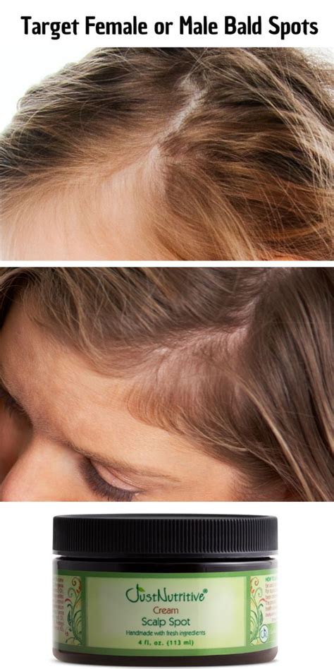 Scalp Spot Cream To Help W Hair Loss Just Nutritive