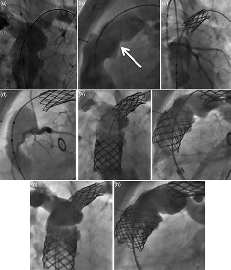 Implantation Of The Edwards Sapien™ Transcatheter Heart Valve Into A