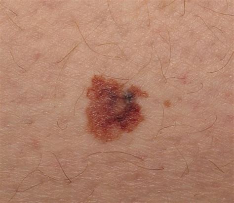 Tipos De Câncer De Pele Melanoma Conselho Médico