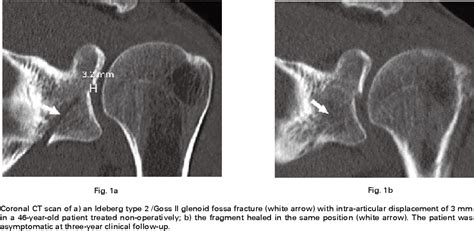 Results Of Non Operative Treatment Of Fractures Of The Glenoid Fossa