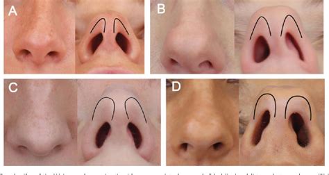 Figure From Normal And Variant Anatomy Of The Nasal Tip Semantic