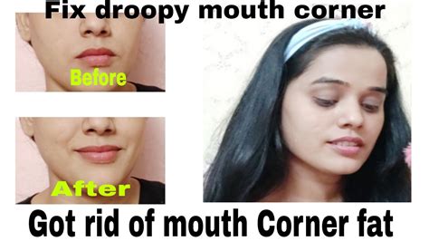 8easy Exercises Get Rid Of Mouth Corner Fatfix Droopy Mouth Corner