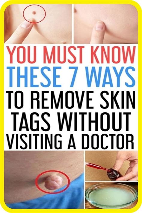 remove warts and skin tags artofit