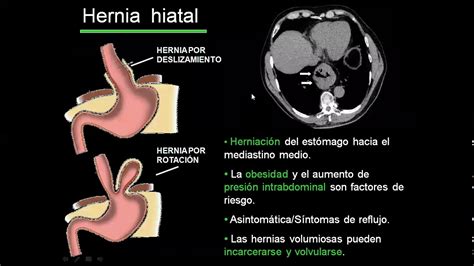 Hernias Diafragmaticas Youtube