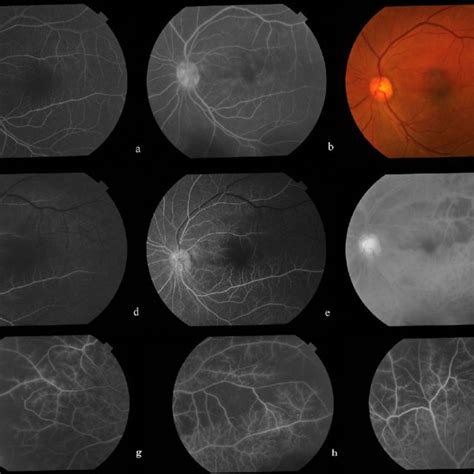 Pdf Recurrent Retinal And Choroidal Ischemia In A Case Of Ocular