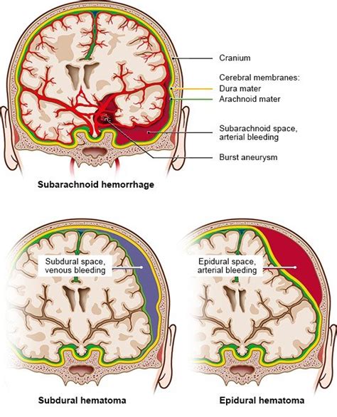 What Happens During A Brain Hemorrhage