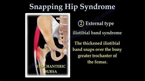 Snapping Hip Syndrome Causes Diagnosis And Treatment Click In The Hip What Does It Mean