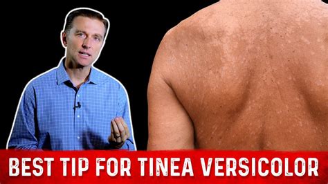 Best Home Remedies For Tinea Versicolor Skin Fungus Keto Course