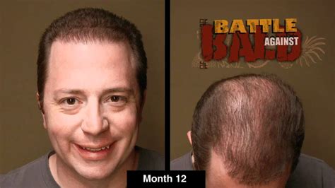 We would recommend going with bosley only if you tried other hair loss treatments with no success, and have a rather large bankroll. Bosley Hair Transplant Results After 12 Months (Time Lapse ...