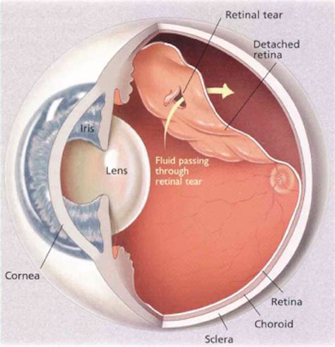 Treatment Of Retinal Detachment Review Of Retinal Detachment