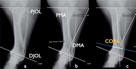 Preoperative Ap View Of A Tibia Affected By Pes Varus Deformity A