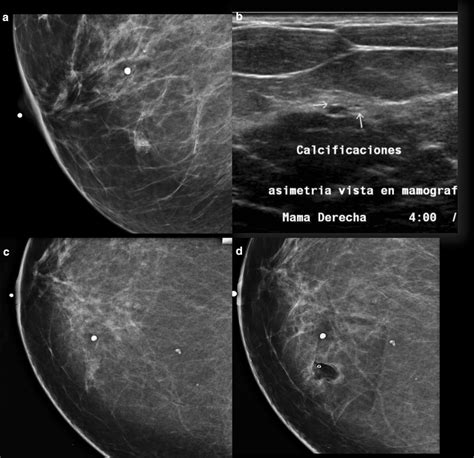 A Mammography Lateral Medial Oblique View Demonstrates A Focal Download Scientific Diagram