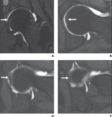 Figure 1—25 From Imaging Appearance Of The Normal And Partially Torn