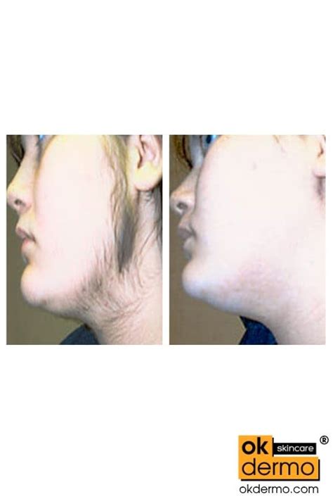 Alibaba.com offers 2,515 hair inhibitors products. Eflora® Cream - Facial Hair Inhibitor [Eflornithine ...