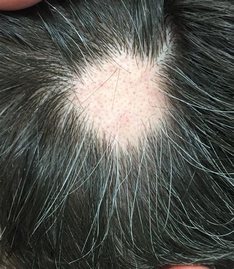 Sudden Bald Spot Is This Cause For Alarm Or Temporary Bald