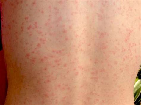 Common Viral Rashes In Babies Childhood Rashes Skin Conditions And
