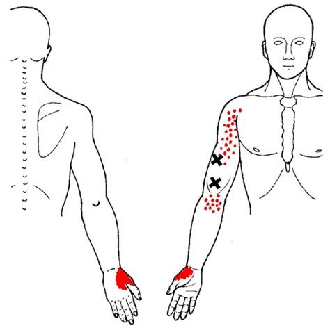 Brachialis Trigger Points And Referred Pain Patterns