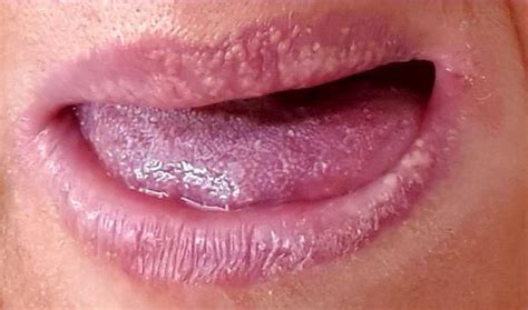 Small Bumps On Tongue Identified By Doctors As Potential Coronavirus