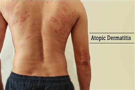 Herbal Remedies For Atopic Dermatitis Ad Signs Symptoms