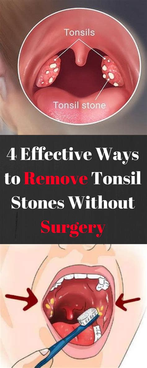 How To Get Rid Of Tonsillitis Food Culinary