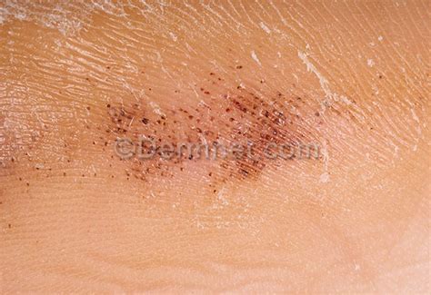 Black Heel Photo Skin Disease Pictures