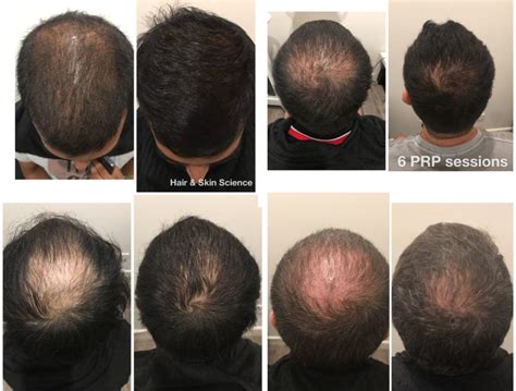 Prp Hair Loss Treatment Sydney Melbourne And Brisbane