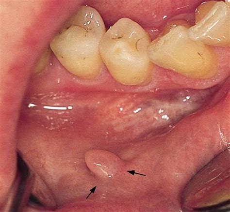 The valaciclovir international herpes simplex virus study group. Schleimhauterkrankungen und -veränderungen