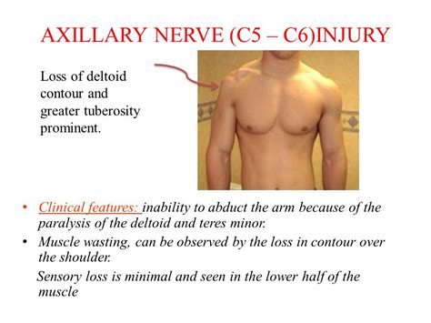 Axillary Nerve Injury Paces