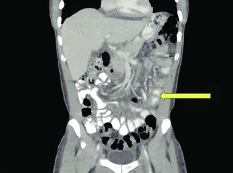 Computed Tomography Scan Of Abdomen And Pelvis With Contrast Showing