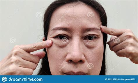 The Flabby Skin And Cellulite Under The Eyes Wrinkles And Ptosis