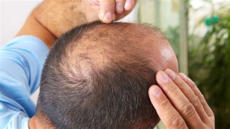 30 Haircuts For Balding Crown Hide Bald Spots Within Minutes