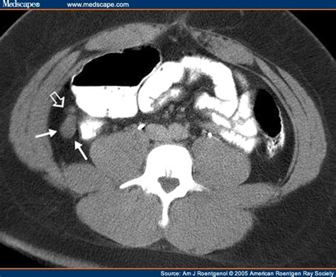 Helical Ct Evaluation Of Acute Right Lower Quadrant Pain 2
