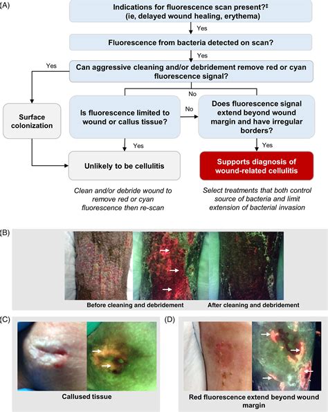 Diagnosis And Treatment Of The Invasive Extension Of Bacteria