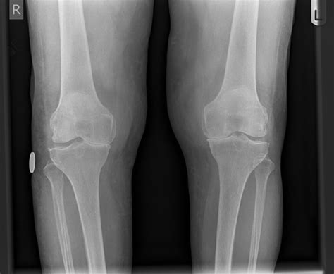 Orthopaedic Surgeon Mr Samuel Parsons Explains Knee Pain